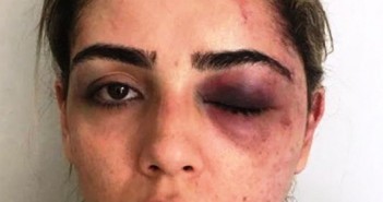 advogada agredia com o lado esquerdo do rosto desfigurado